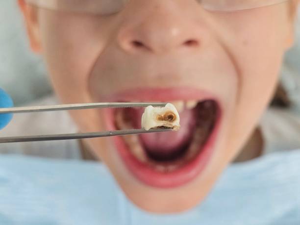 Best Emergency Root Canal Therapy in Rapid City, MI