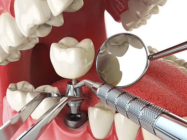 Best Broken or Chipped Tooth Repair in Rapid City, MI